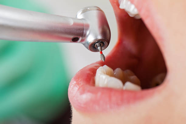 Best Emergency Tooth Extraction in Risg Sun, IN